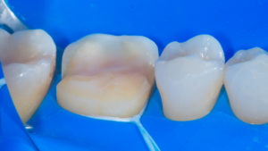 Dental procedure