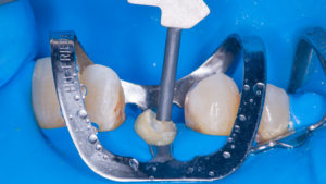Dental procedure