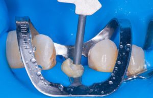 Dental procedure