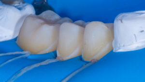 Dental procedure