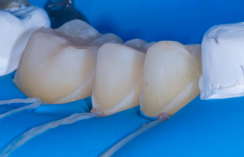 Dental procedure