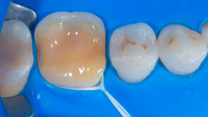 Dental procedure