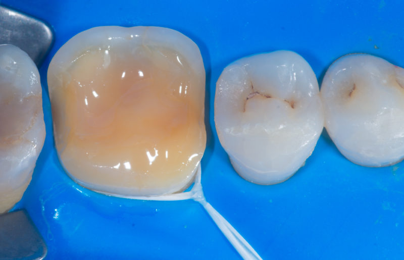 Dental procedure