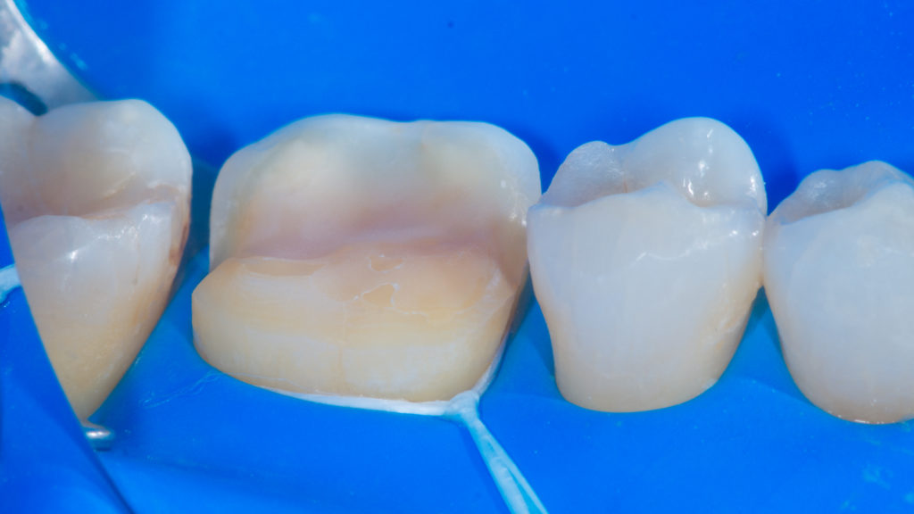 Dental procedure