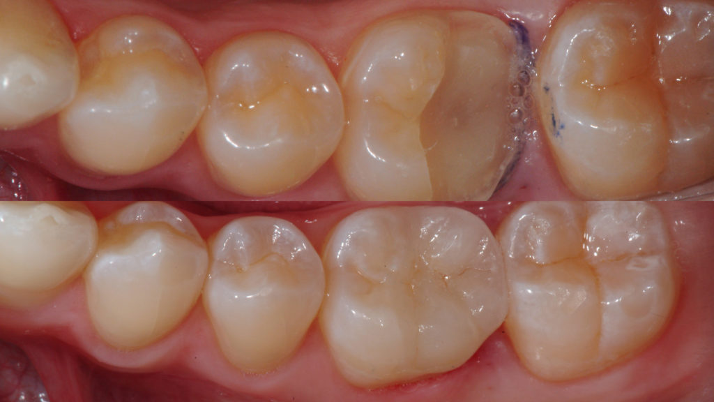 Teeth before and after