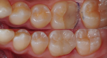 Teeth before and after