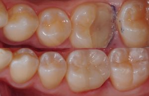 Teeth before and after