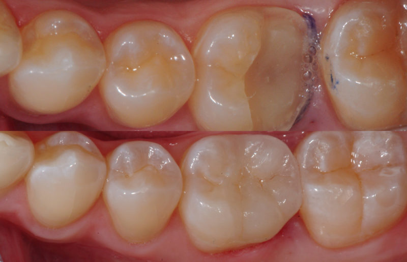 Teeth before and after