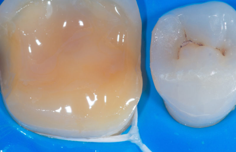 Dental procedure
