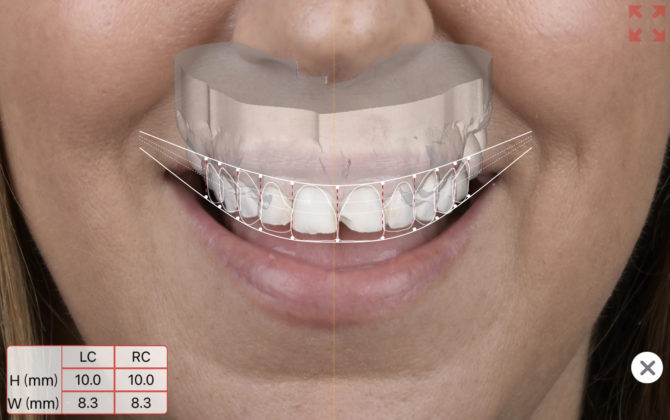 Smile Design Process for Cosmetic Dentistry