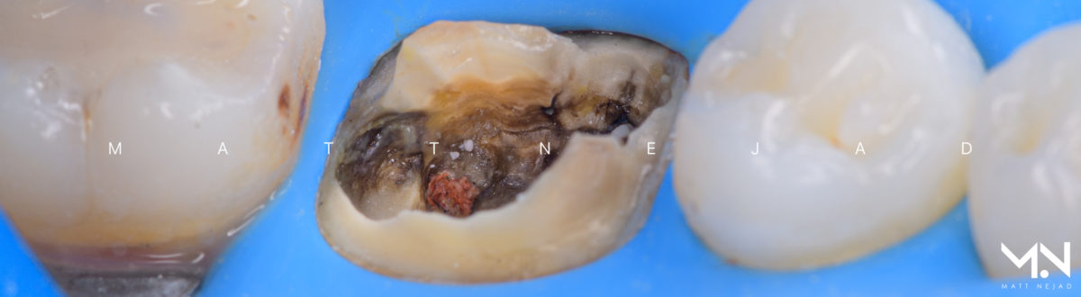 Remaining tooth structure after restoration failure that is not restorable with traditional dentistry.