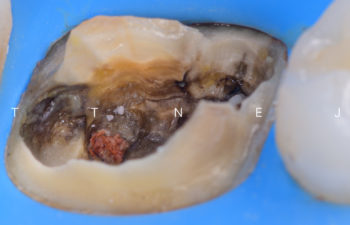 Remaining tooth structure after restoration failure that is not restorable with traditional dentistry.