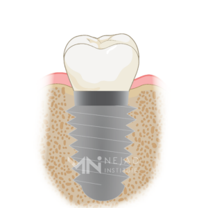 Biomimetic Dentistry & The Tooth Cycle of Death - Step 10