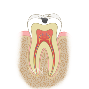 Biomimetic Dentistry & The Tooth Cycle of Death - Step 2