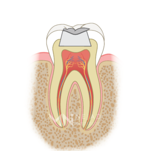 Biomimetic Dentistry & The Tooth Cycle of Death - Step 3