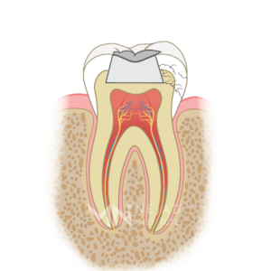 Biomimetic Dentistry & The Tooth Cycle of Death - Step 4