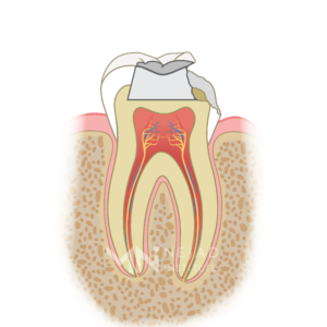Biomimetic Dentistry & The Tooth Cycle of Death - Step 5