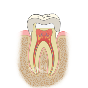 Biomimetic Dentistry & The Tooth Cycle of Death - Step 6