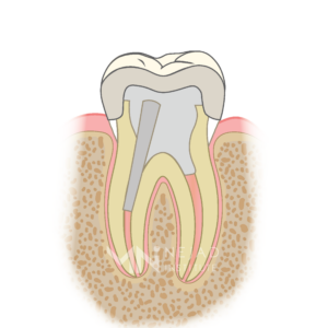 Biomimetic Dentistry & The Tooth Cycle of Death - Step 8