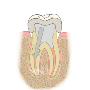 Biomimetic Dentistry & The Tooth Cycle of Death - Step 9