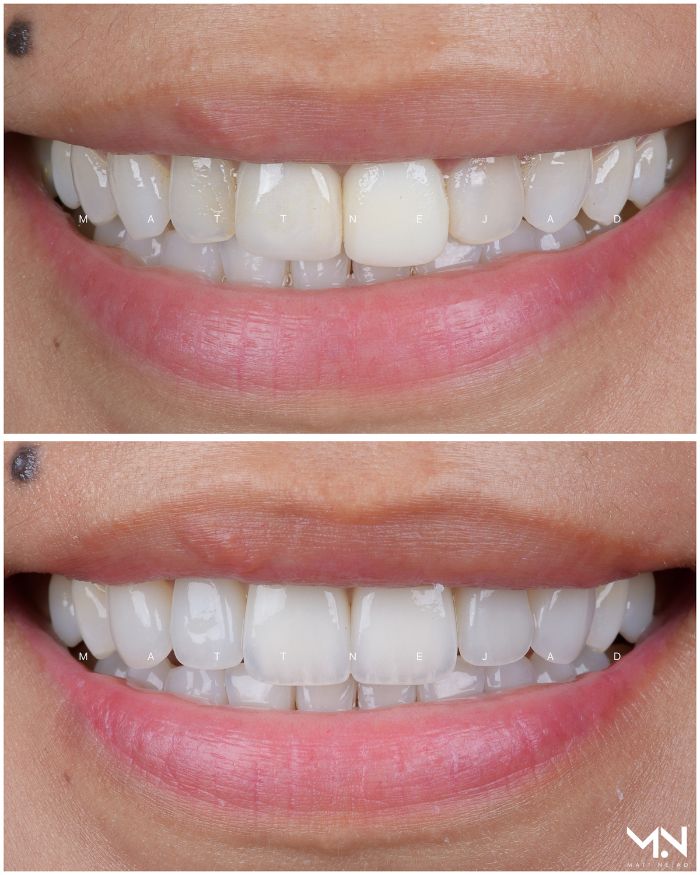 Closeup before & after- veneers