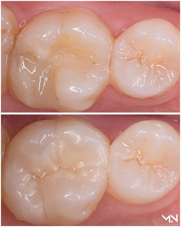 Biomimetic restoration - ceramic inlay