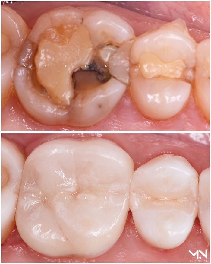 Biomimetic restoration - ceramic inlay & ceramic onlay