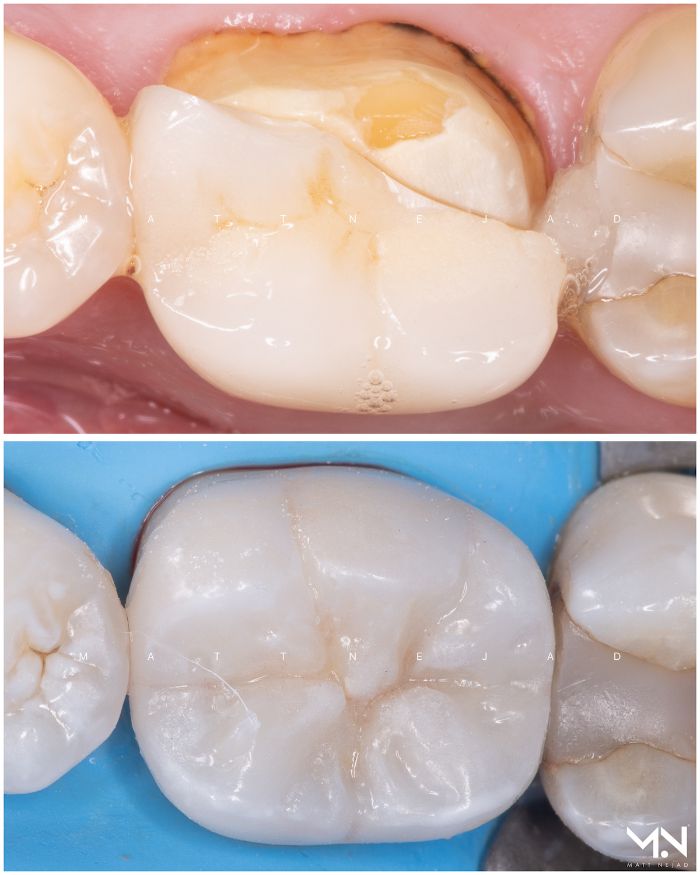 Biomimetic restoration- Ceramic crown