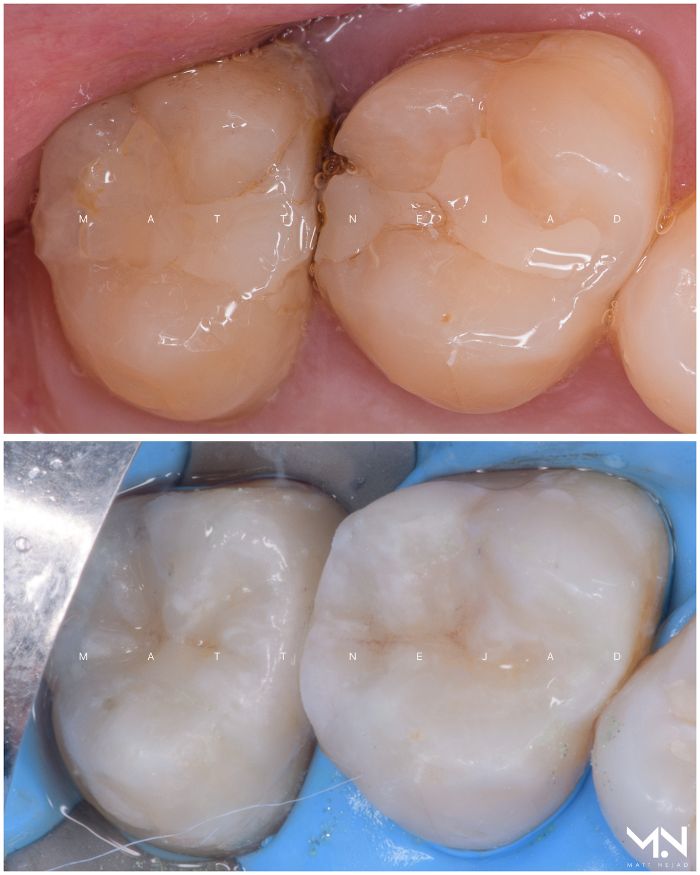 Biomimetic restoration - Ceramic inlays