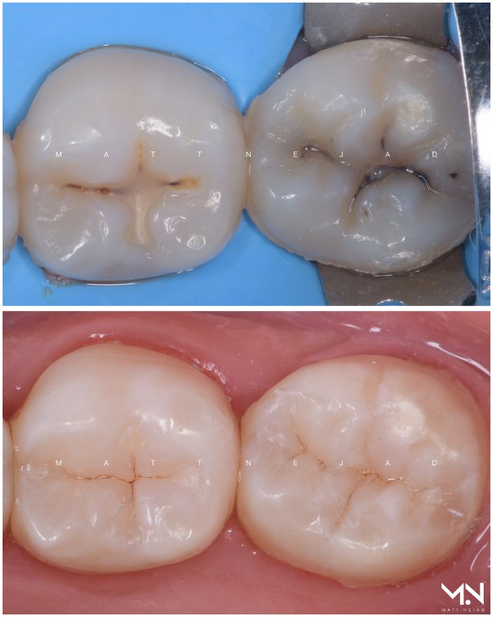 Biomimetic restoration - Composite fillings