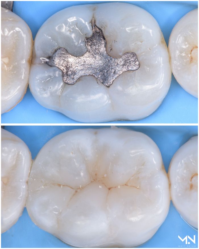 Biomimetic restoration - composite filling