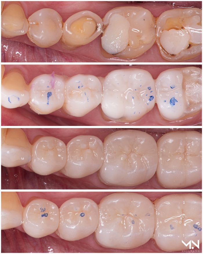 Before and After