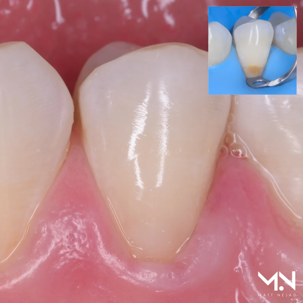 Seamless Class V biomimetic restoration — adhesive technique result