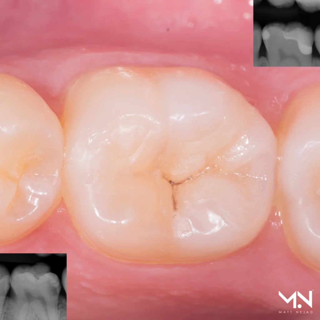Biomimetic deep margin elevation with before and after radiographs