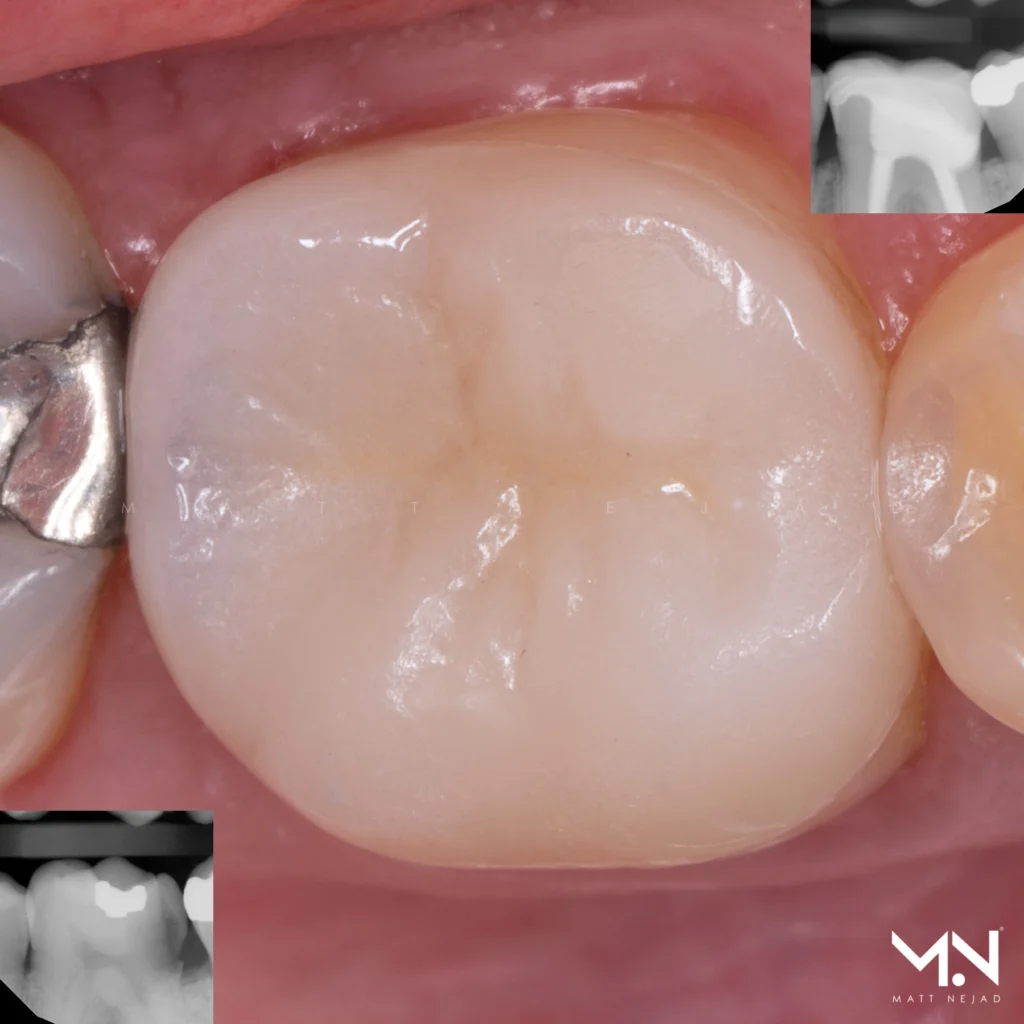 Biomimetic deep margin elevation technique with an adhesive onlay restoration