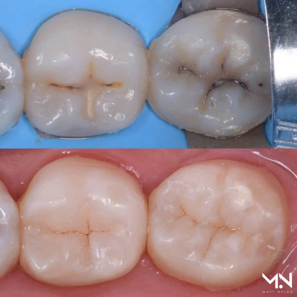 Before and after biomimetic direct composite restorations — natural tooth structure preserved