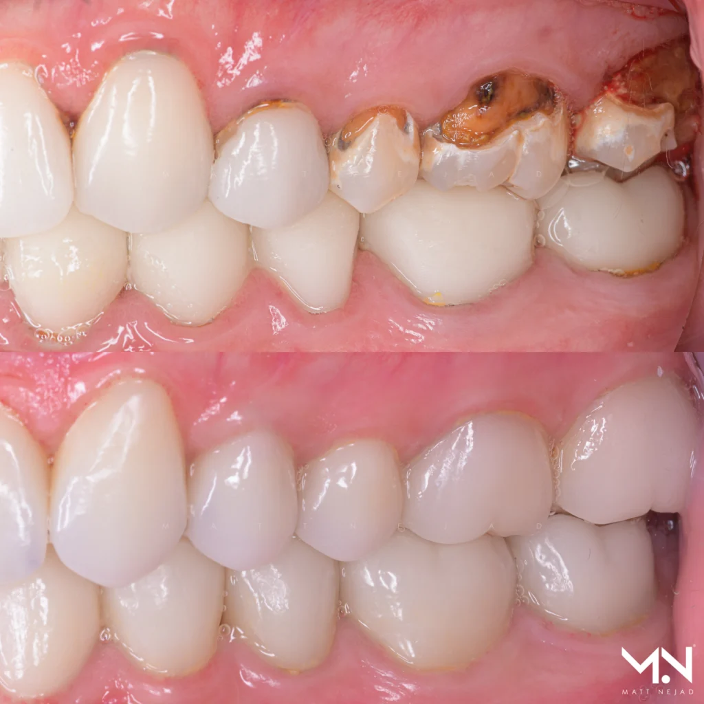 Full mouth rehabilitation using biomimetic dentistry techniques