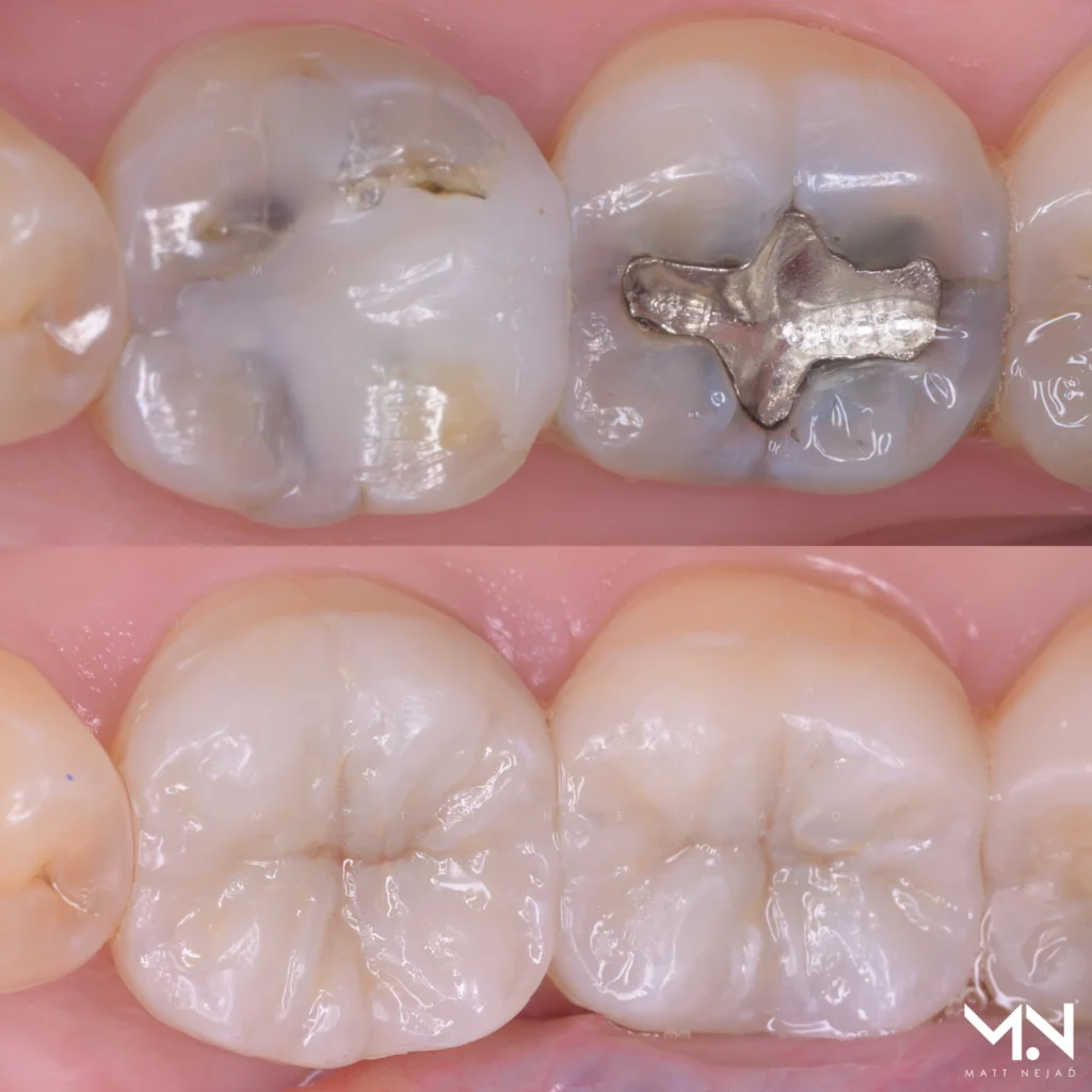 Biomimetic onlay restoration — natural tooth structure preserved