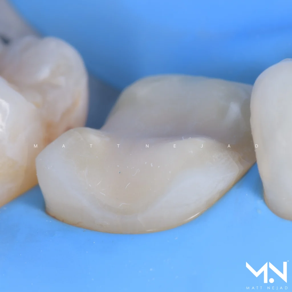 The Biomimetic restorative foundation — adhesive bonding preparation technique
