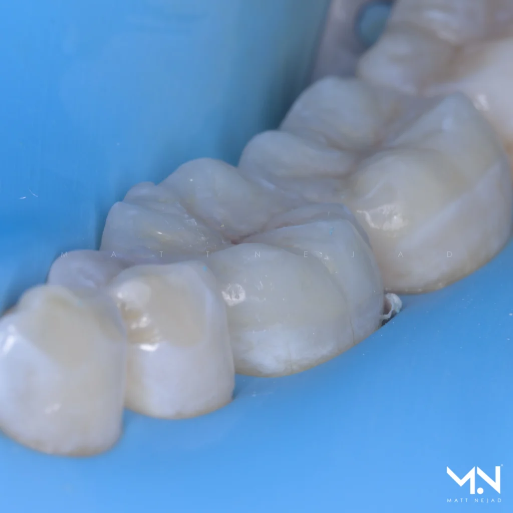 Seamless biomimetic onlay margins — adhesive restoration technique